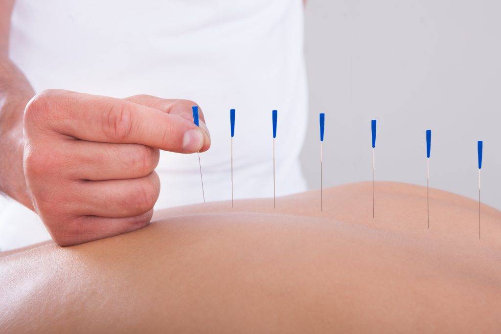 Aignuille d'acupuncture sur le dos